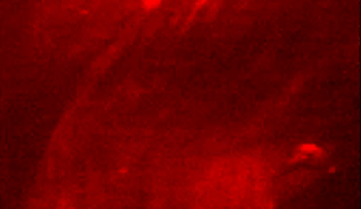 Cardiovascular Disease