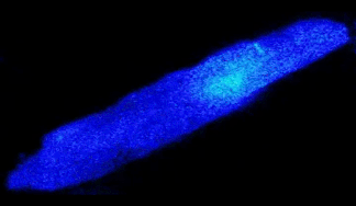 Cardiovascular Disease